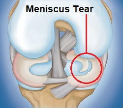 Meniscus Tear