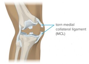 Medial Collateral ligament